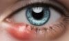 Home Remedies and Causes for Eye Styes Explained