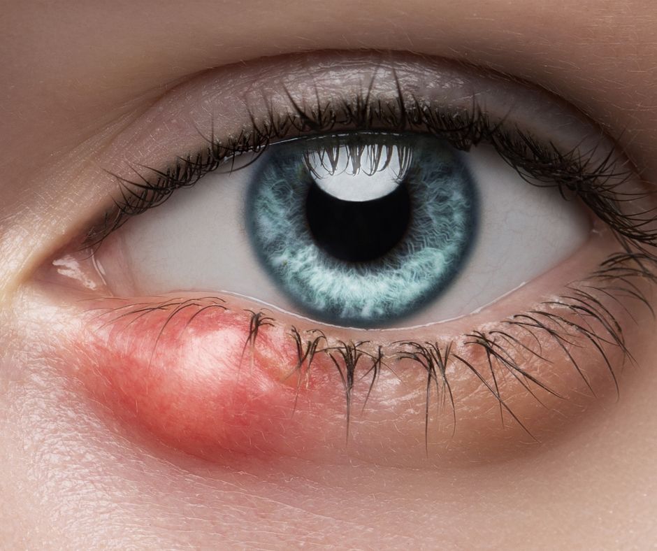 Home Remedies and Causes for Eye Styes Explained